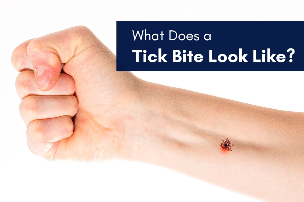 What Does a Tick Bite Look Like?